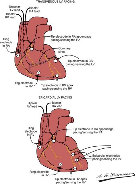 lv leads|lv lead revision.